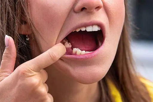 Mơ thấy bị rụng răng là điềm báo điều gì? Mơ thấy bị rụng răng
