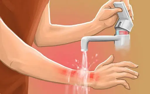 Mơ thấy bị bỏng là điềm báo điều gì? Mơ thấy bị bỏng